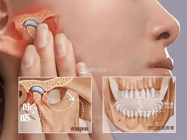 00后女生一觉醒来无法张嘴：确诊“T M D”